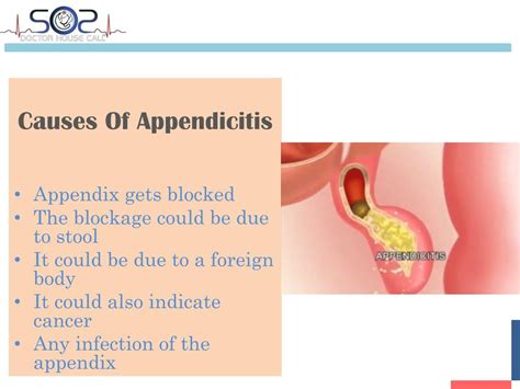 PPT - Los Angeles Doctor on Demand - How to Prevent Appendicitis PowerPoint Presentation - ID ...