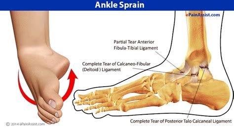 Five Major Reasons for a Sprained Ankle – Convenient How to trade options Methods – What