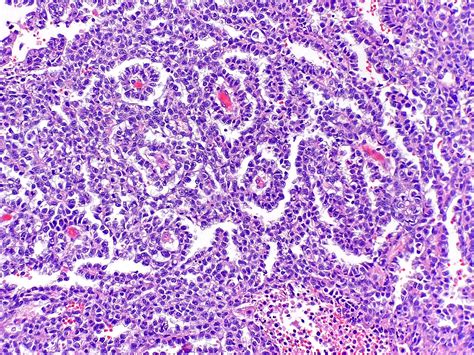 Yolk Sac Tumor Schiller Duval Bodies