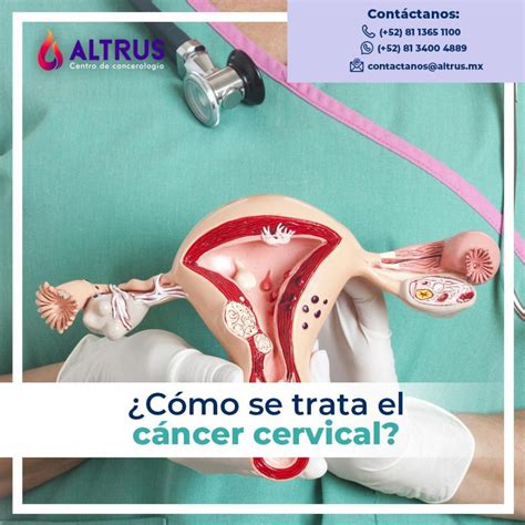 Tratamiento cáncer cervical - ALTRUS cancerología