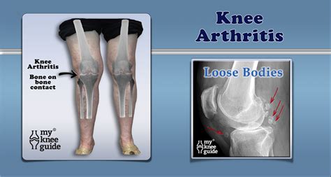 Arthritis In Knee X Ray - Sigila Mencurah Pedih
