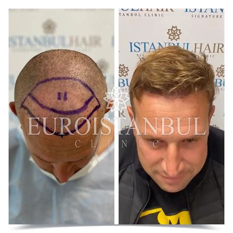 Best Friends Hair Transplant Package (3 People) in Turkey ⭐ €4,950