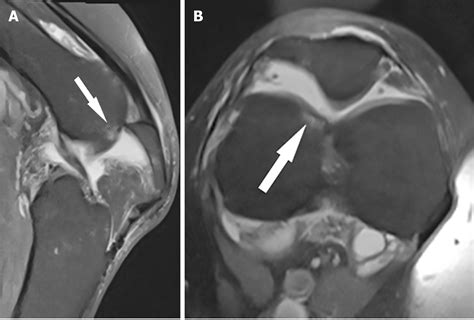 Inferior patella dislocation in an elderly patient after a fall: A case report