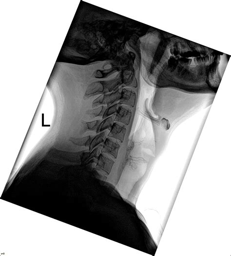 Xray Soft Tissue Neck Epomedicine