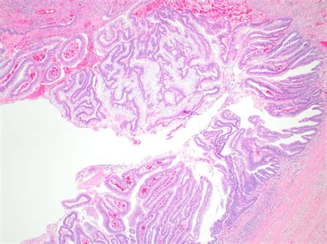 Tubular Adenoma