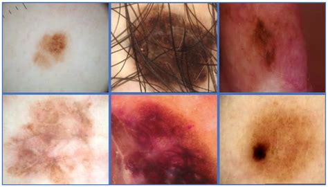 Skin Lesion Segmentation Based on Vision Transformers and Convolutional ...