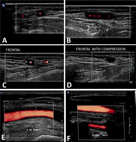 Ultrasonography of the superficial temporal and axillary arteries in ...