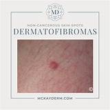 Understanding Non-Cancerous Skin Spots — and When to Consult a ...