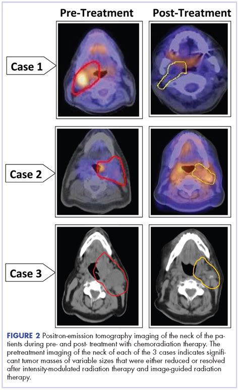 Tonsil Cancer Stage 1