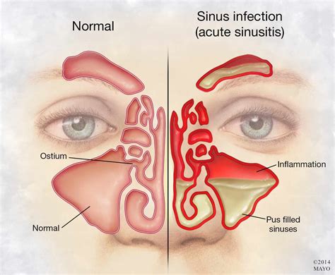 Does A Sinus Infection Make You Cough Up Blood at John Pavon blog