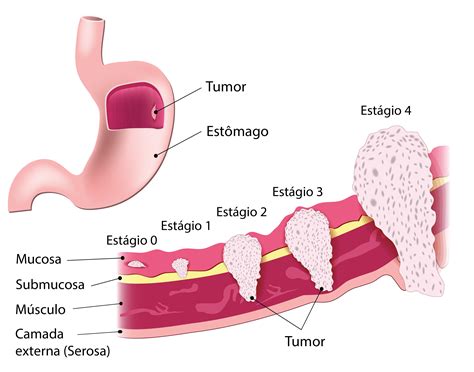 Liston De Cancer De Estomago