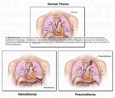 Types Of Hemopneumothorax at Clinton Spears blog