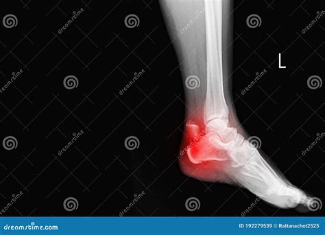 Film Ankle X-ray Radiograph Showing Heel Bone Broken Close Fracture Calcaneus . Medical ...