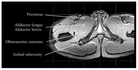 Toward a Better Understanding of Hip Adductor Function: Internal Rotation Capability Revealed by ...