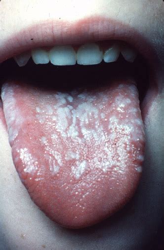 Bildergebnis für candida paragusa