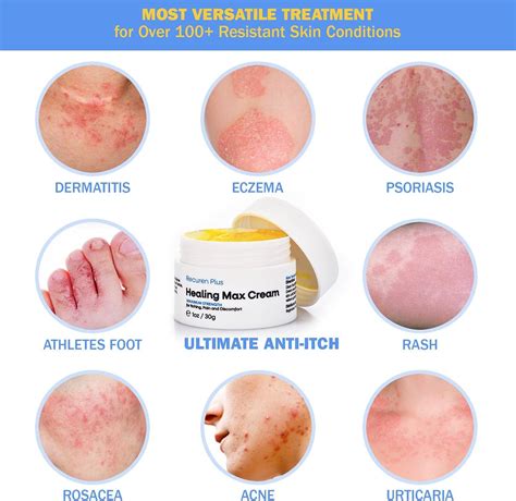 Recuren Plus Dermatitis Eczema Psoriasis Cream 30g - Ultimate Anti-Itch ...