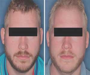 Nitisinone protects against UV light and promotes normal vision in albinism