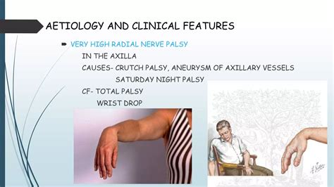 RADIAL NERVE PALSY[1].pptx