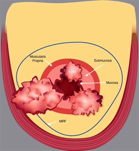 Low Rectal Cancers at Initial Staging MRI | RadioGraphics