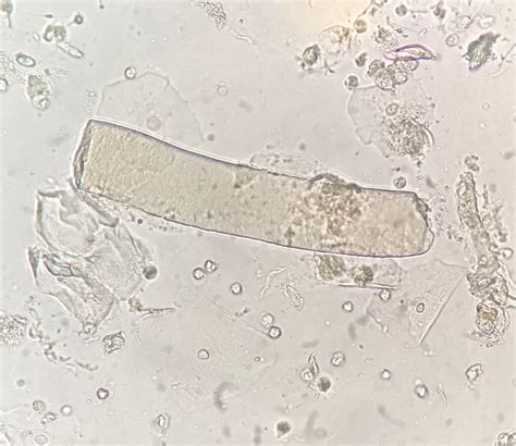 Epithelial Casts In Urine