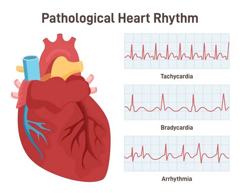 Arrhythmia Definition 的图像结果