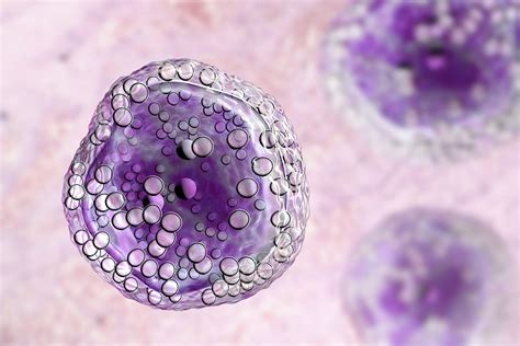 Diffuse large B-cell lymphoma Prognosis - Rare Disease Advisor