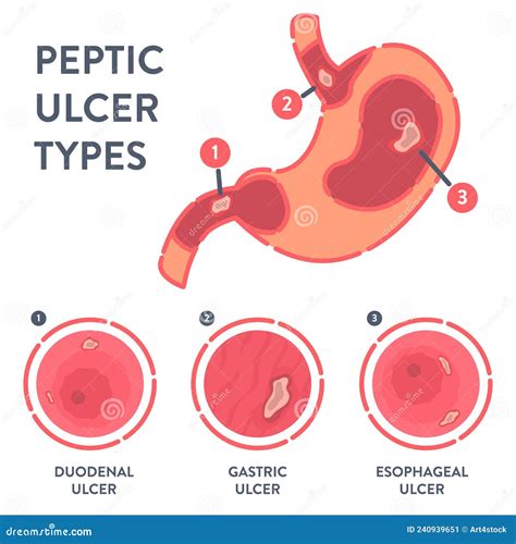 Types Of Peptic Ulcer Stomach Disease Infographics Cartoon Vector ...