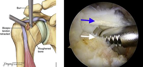 Arthroscopic Onlay Articular Margin Biceps Tenodesis for Long Head of ...