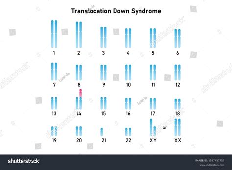 Translocation Down Syndrome Science Design Vector Stock Vector (Royalty ...