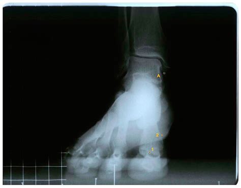 Static Range of Motion of the First Metatarsal in the Sagittal and ...