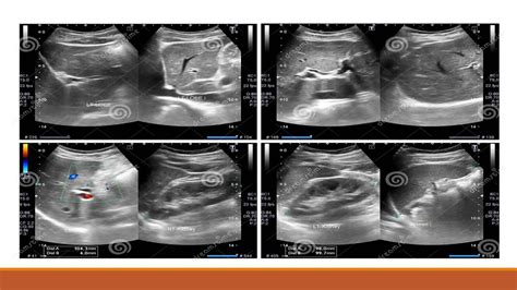 Abdomen ultrasound.pptx