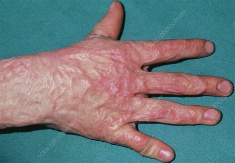 Image result for third degree burn scar