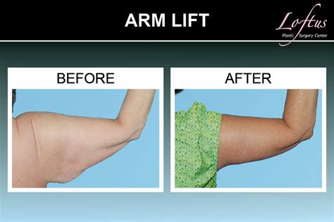 Arm Lift Operation