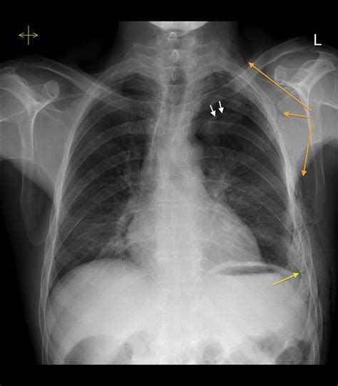 Tension Pneumothorax X Ray Chest X Ray Interpretation | A Structured