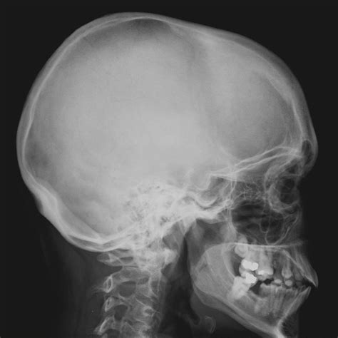Lateral Skull X Ray Labeled at Diane Gilbreath blog