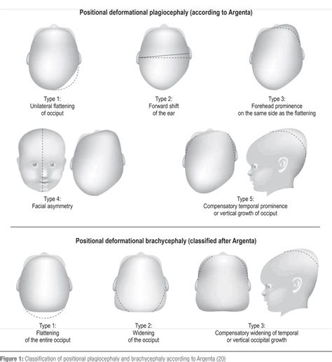 Positional Skull Deformities (07.08.2017)