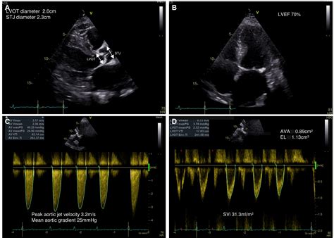 Aortic valve stenosis | The Bergen Hypertension and Cardiac Dynamics Group | UiB