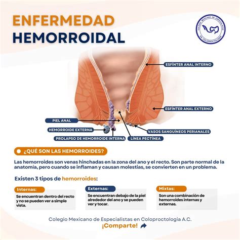 Como Son Las Hemorroides