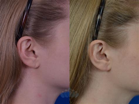 Earlobe Repair Before and After Pictures Case 82 | Charlotte, NC | Dilworth Facial Plastic Surgery