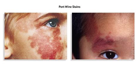 Vascular Birthmarks | AMBOSS Rotation Prep