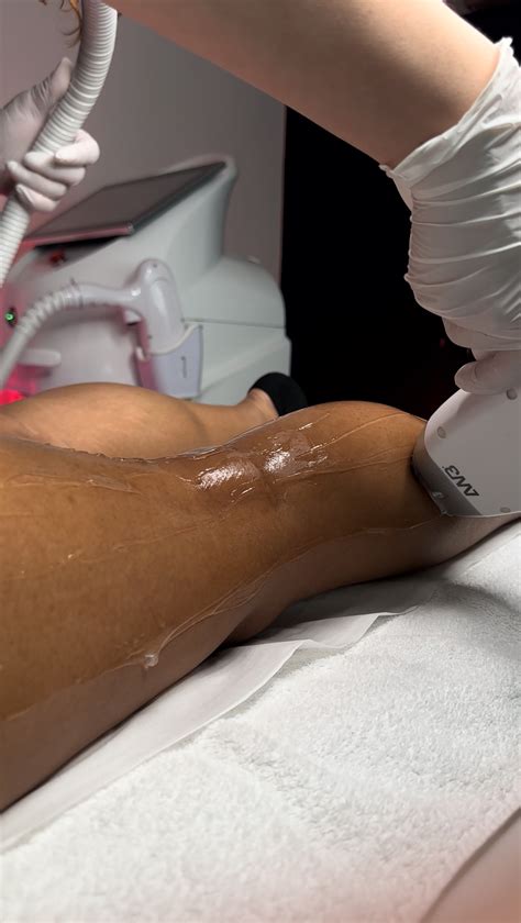 Does Laser Really Remove Hair Permanently? - Faces By Bae