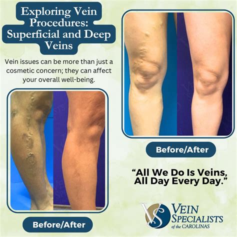 12 Superficial and Deep Vein Procedures - Vein Specialists of the Carolinas