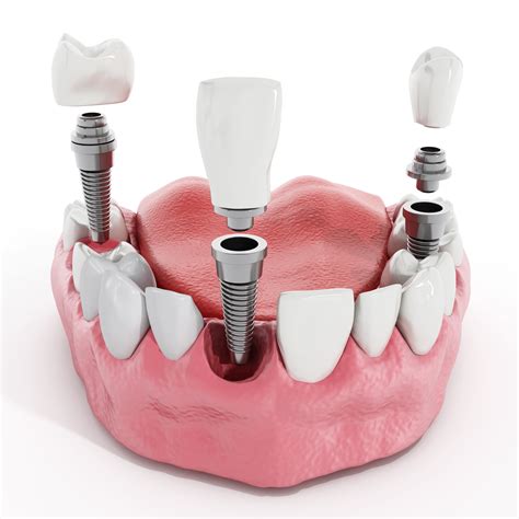 Dental Implant Crown | How Implant Crowns Work – Lake Forest Dental
