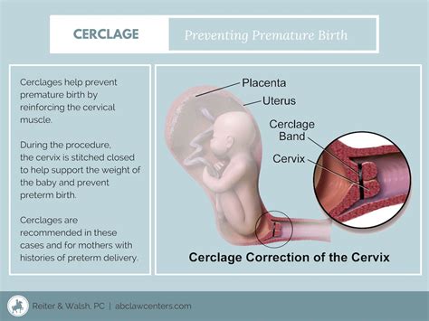 Cerclage to Prevent Preterm Birth in Mothers with a Short or Incompetent Cervix | Premature ...