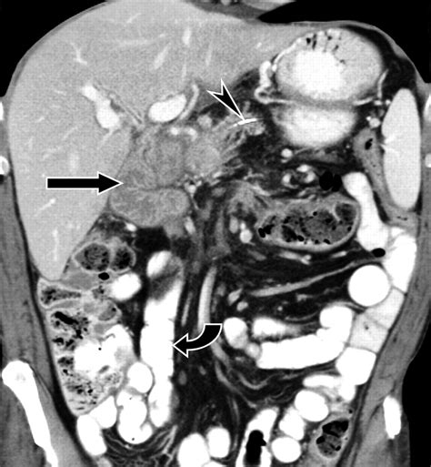 Small-Bowel Complications of Major Gastrointestinal Tract Surgery | AJR