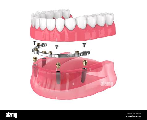 Bar retained removable overdenture installation supported by implants over white backgroud Stock ...