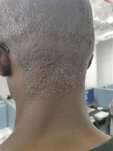 Razor Bump Cure and Prevention Tips? : r/bald