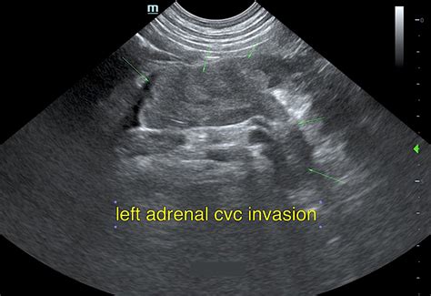 Left Adrenal Mass With Caval Invasion: Our Case Of the Month February ...
