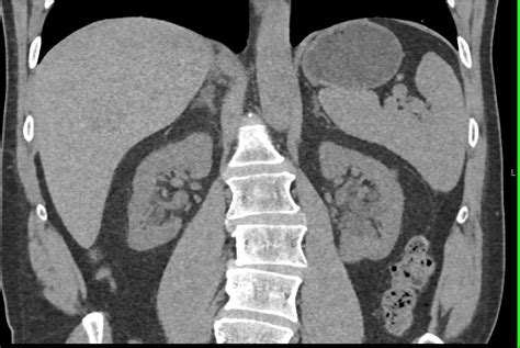Kuvatulokset haulle parapelvic cyst kidney