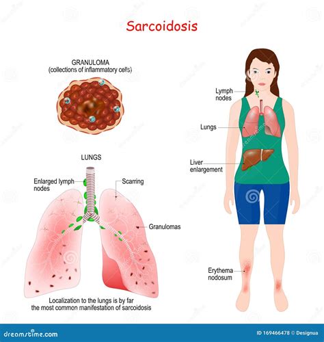 Sarcoidosis Signs and Symptoms. Development of Granulomas Stock Vector - Illustration of immune ...